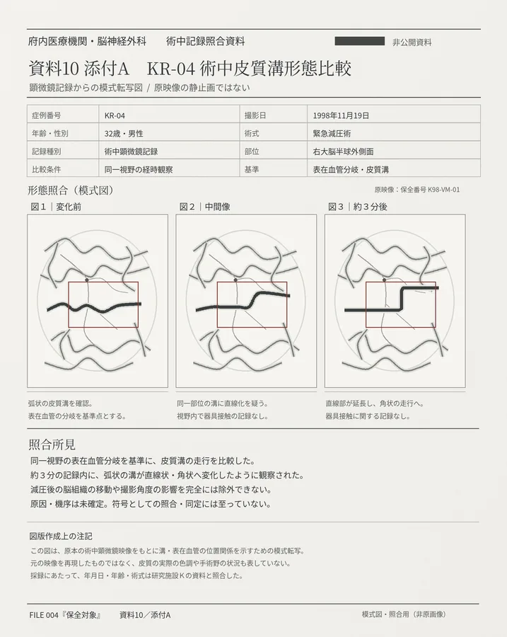 資料10 添付A：術中映像の模式転写。緊急減圧術中の映像をもとに、皮質溝の走行が変化した箇所を比較した模式図。術中写真そのものではない。