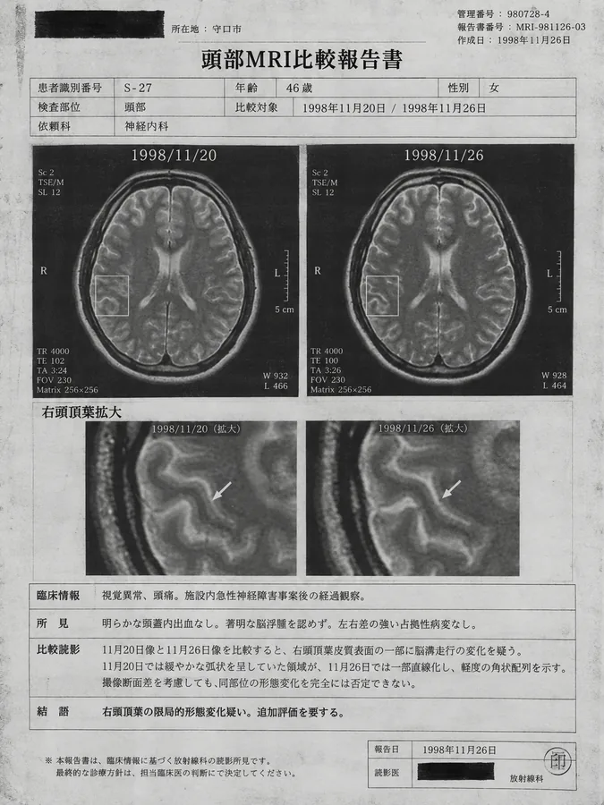 資料10 添付B：追跡神経画像。症状が軽快した生存症例S-27（46歳女性）の画像比較。右頭頂葉の限局した脳溝の走行差を検討している。